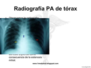 Radiografía PA de tórax
• Observamos la radiografía
  típica de un paciente con
  estenosis mitral, donde
  apreciamos en fecha amarilla
  un doble contorno en reborde
  cardiaco derecho, en fecha
  azul un aumento del ángulo de
  la carina y en flecha roja un
  enderezamiento del borde
  izquierdo de la silueta
  cardiaca, todo esto indicando
  crecimiento de la de la
  aurícula izquierda como
  consecuencia de la estenosis
  mitral.
                      www.1medsalud.blogspot.com
 