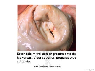 Estenosis mitral con engrosamiento de
las valvas. Vista superior, preparado de
autopsia.
           www.1medsalud.blogspot.com
 