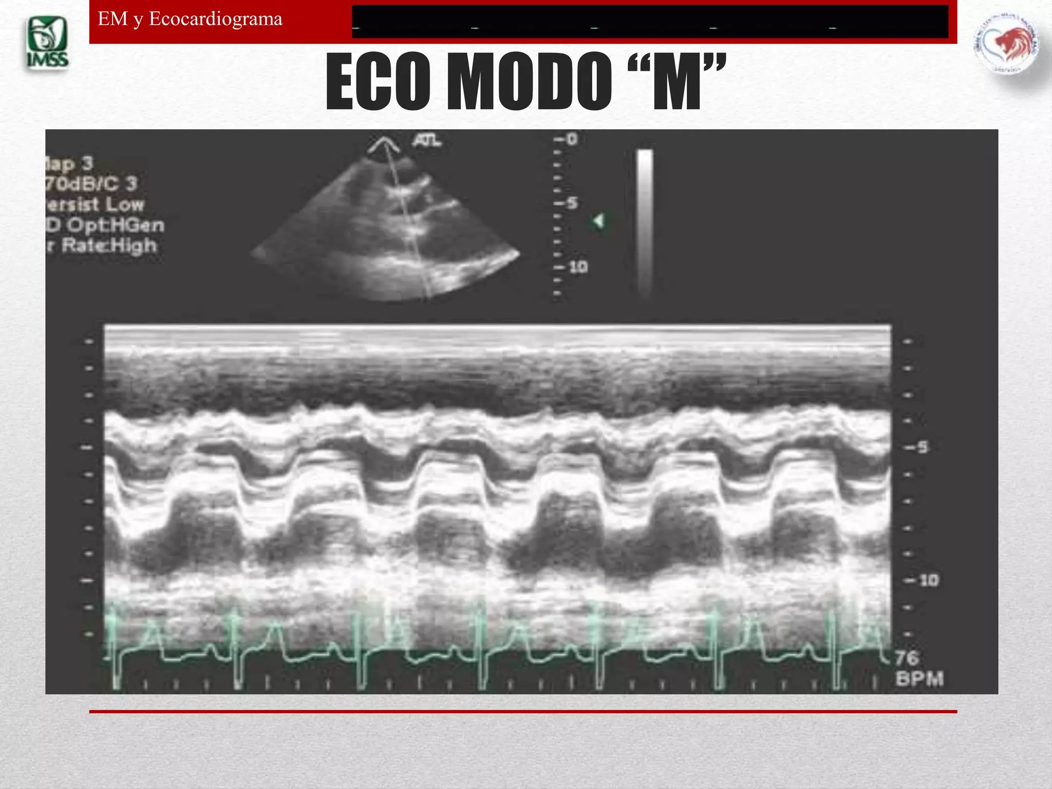 Estenosis mitral y ecocardiograma | PPTX