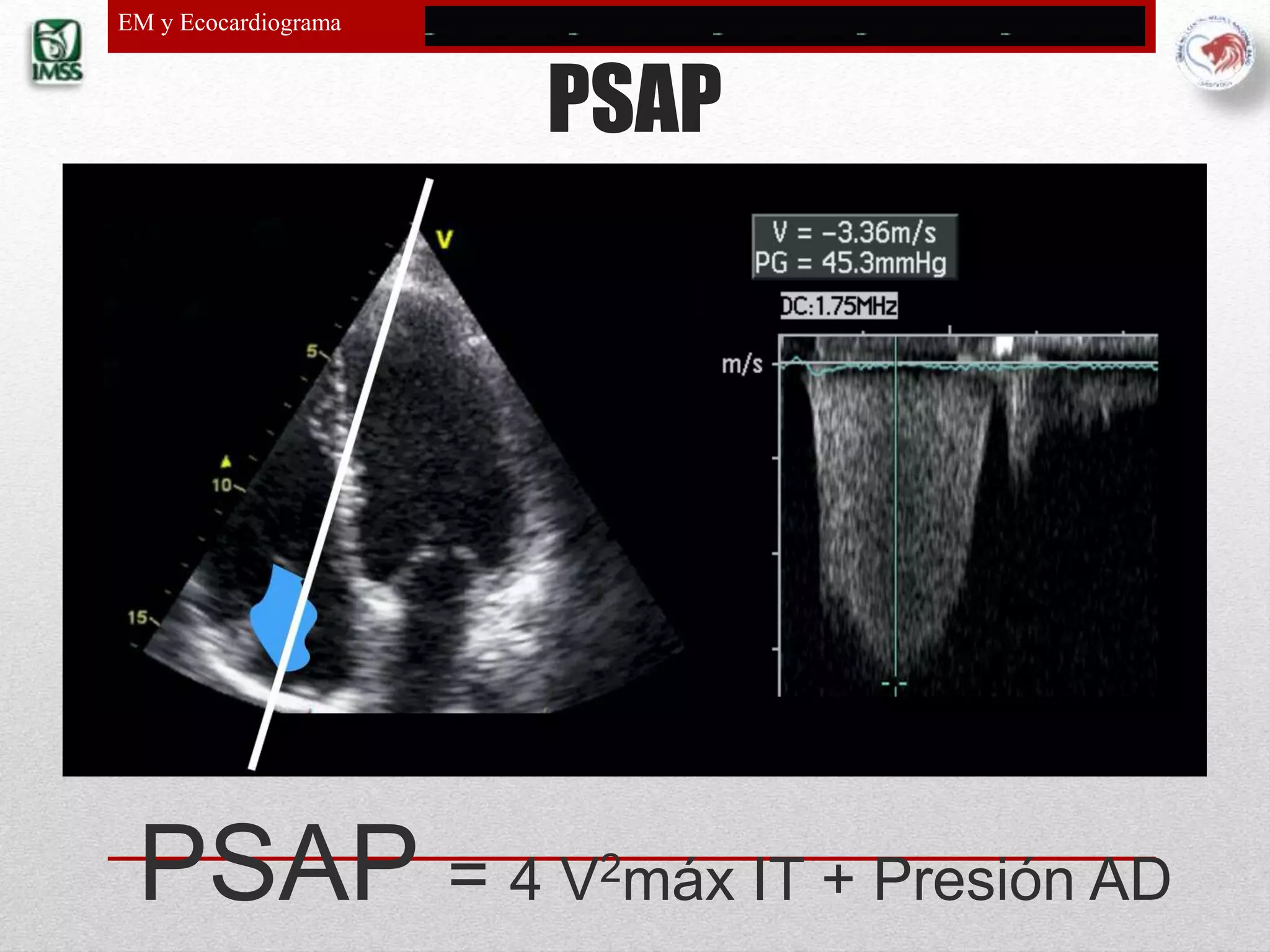 Estenosis mitral y ecocardiograma | PPTX