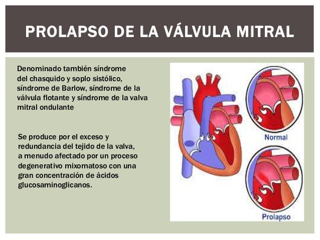 Prolapso de la válvula mitral