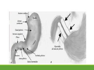 Estenosis pilorica | PPTX