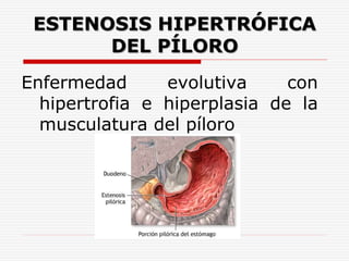 Estenosis pilorica daniel pinito 2015 | PPTX