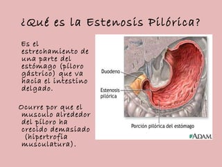 ¿Qué es la Estenosis Pilórica?
Es el
estrechamiento de
una parte del
estómago (píloro
gástrico) que va
hacia el intestino
...