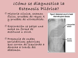¿Cómo se diagnostica la
       Estenosis Pilórica?
@ Historia clínica, examen
  físico, pruebas de rayos X
  y pruebas de ...