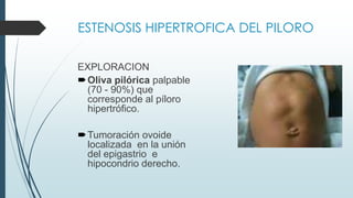 ESTENOSIS HIPERTROFICA DEL PILORO
Cuadro clínico:
Onda gástrica.
( antiperistáltica) de manera característica de
izquier...