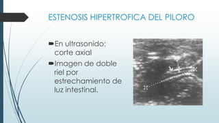ESTENOSIS HIPERTROFICA DEL PILORO
En ultrasonido:
corte axial
Imagen “ojo de
bovino” “dona”
Imagen tiro al
blanco
 
