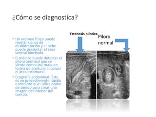 Estenosis pilorica | PPTX