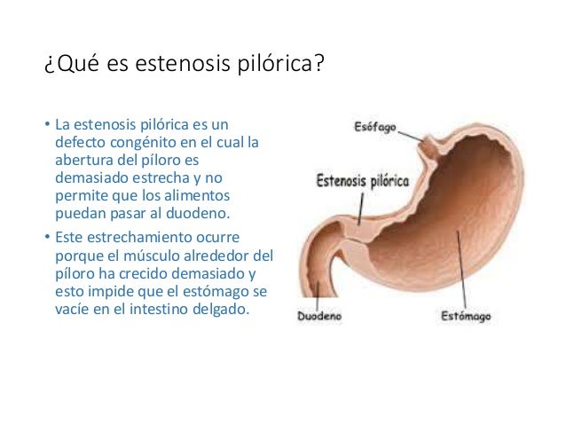 Estenose Pilorica Radiografia Estenosis Pilorica