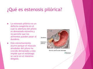 Estenosis pilórica | PPTX