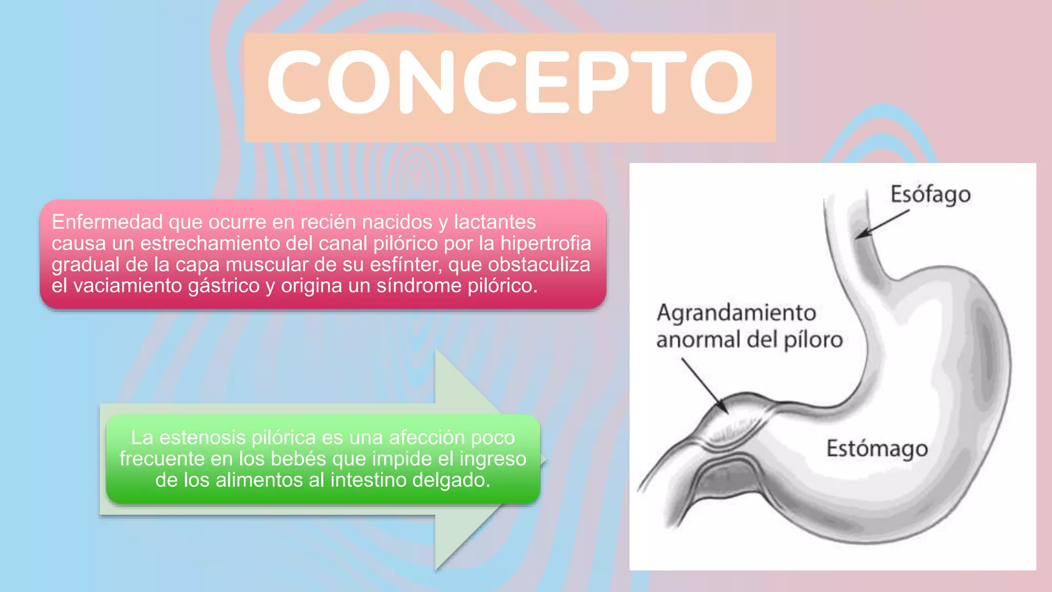 Estenosis pilórica.pptx