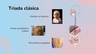 Estenosis pilórica.pptx