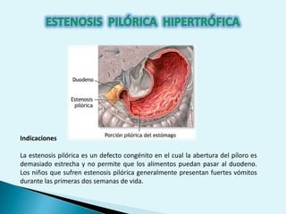Estenosis pilórica hipertrofica. | PPTX