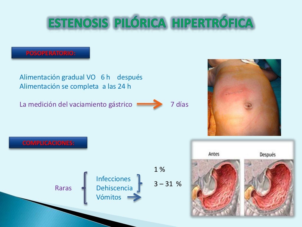 Estenosis pilórica hipertrofica.