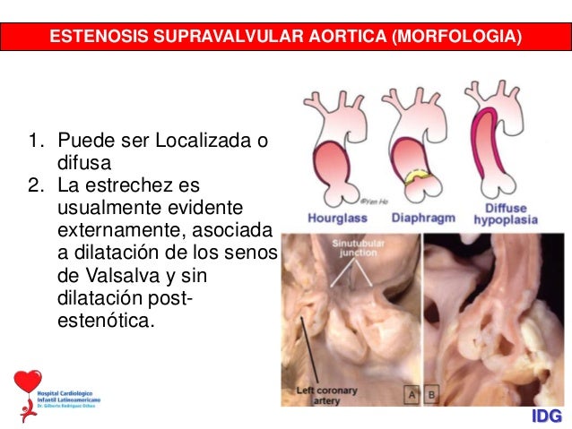 Estenosis supravalvular aórtica