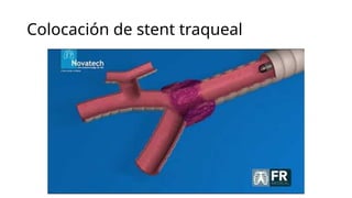 Manejo quirúrgico de la estenosis traqueal.pptx