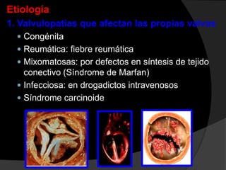 Etiología
1. Valvulopatias que afectan las propias valvas
 Congénita

 Reumática: fiebre reumática
 Mixomatosas: por defectos en síntesis de tejido

conectivo (Síndrome de Marfan)
 Infecciosa: en drogadictos intravenosos
 Síndrome carcinoide

 