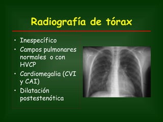 Radiografía de tórax
• Inespecífico
• Campos pulmonares
  normales o con
  HVCP
• Cardiomegalia (CVI
  y CAI)
• Dilatación
  postestenótica
 