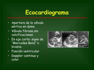 Ecocardiograma
• Apertura de la válvula
  aórtica en domo
• Válvula fibrosa sin
  calcificaciones
• En eje corto: signo de
  “Mercedes Benz” o
  bivalva
• Función ventricular
• Doppler continuo y
  color
 