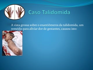 A vista grossa sobre o enantiômeros da talidomida, um 
remédio para aliviar dor de gestantes, causou isto: 
 