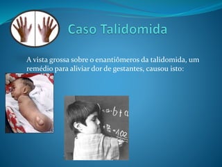 A vista grossa sobre o enantiômeros da talidomida, um 
remédio para aliviar dor de gestantes, causou isto: 
 
