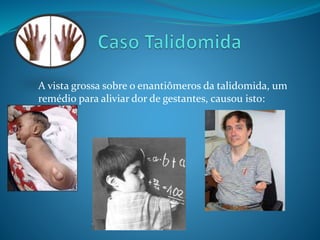 A vista grossa sobre o enantiômeros da talidomida, um 
remédio para aliviar dor de gestantes, causou isto: 
 