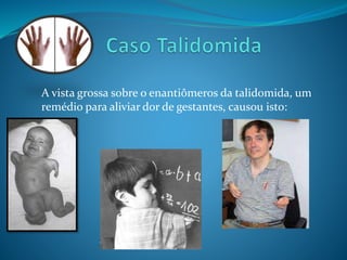 A vista grossa sobre o enantiômeros da talidomida, um 
remédio para aliviar dor de gestantes, causou isto: 
 