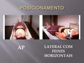 AP LATERAL COM
FEIXES
HORIZONTAIS
 