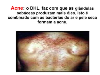 Acne :   o DHL, faz com que as   glândulas sebáceas produzam mais óleo, isto é combinado com as bactérias do ar e pele seca formam a acne. 