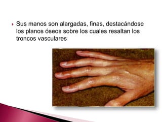  Sus manos son alargadas, finas, destacándose 
los planos óseos sobre los cuales resaltan los 
troncos vasculares 
 