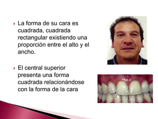  La forma de su cara es 
cuadrada, cuadrada 
rectangular existiendo una 
proporción entre el alto y el 
ancho. 
 El central superior 
presenta una forma 
cuadrada relacionándose 
con la forma de la cara 
 