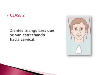  CLASE 2 
Dientes triangulares que 
se van estrechando 
hacia cervical. 
 