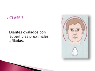  CLASE 3 
Dientes ovalados con 
superficies proximales 
afiladas. 
 