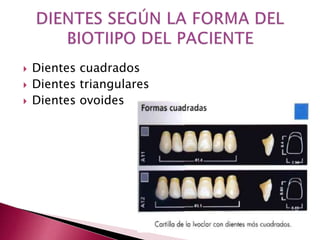  Dientes cuadrados 
 Dientes triangulares 
 Dientes ovoides 
 