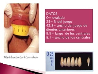 DATOS 
O= ovalado 
25= N del juego 
42,8= ancho del juego de 
dientes anteriores 
9.9= largo de los centrales 
8,1= ancho de los centrales 
 