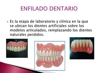  Es la etapa de laboratorio y clínica en la que 
se ubican los dientes artificiales sobre los 
modelos articulados, remplazando los dientes 
naturales perdidos. 
 