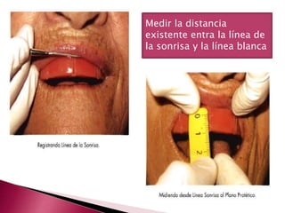 Medir la distancia 
existente entra la línea de 
la sonrisa y la línea blanca 
 