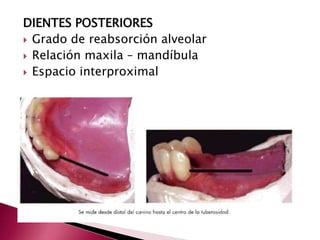 DIENTES POSTERIORES 
 Grado de reabsorción alveolar 
 Relación maxila – mandíbula 
 Espacio interproximal 
 