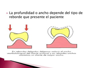  La profundidad o ancho depende del tipo de 
reborde que presente el paciente 
 