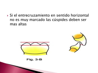  Si el entrecruzamiento en sentido horizontal 
no es muy marcado las cúspides deben ser 
mas altas 
 