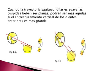 Cuando la trayectoria sagitocondilar es suave las 
cúspides beben ser planas, podrán ser mas agudas 
si el entrecruzamiento vertical de los dientes 
anteriores es mas grande 
 