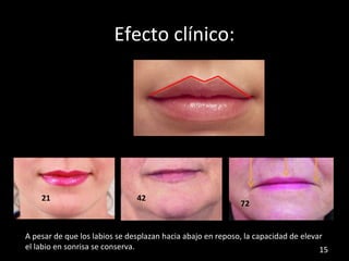 Labio Reposo Estetica facial y dental crecimiento, maduracion y envejecimineto | ODP