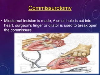 Valvular Heart Disease, Esther | PPTX