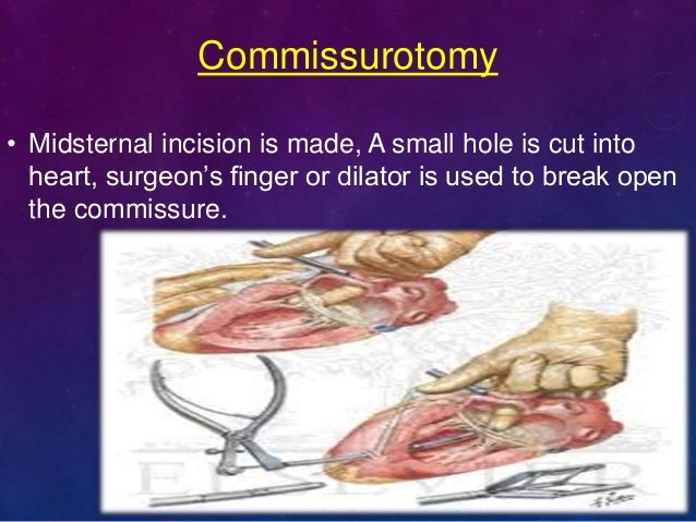 Valvular Heart Disease, Esther