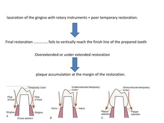 laceration of the gingiva with rotary instruments + poor temporary restoration.
Final restoration …………… fails to vertically reach the finish line of the prepared tooth
Overextended or under extended restoration
plaque accumulation at the margin of the restoration.
 