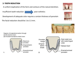 A uniform duplication of the form and contours of the natural dentition.
2- TOOTH REDUCTION
Insufficient tooth reduction poor esthetics
Development of adequate color requires a certain thickness of porcelain
The facial reduction should be 1 to 1.5 mm.
 