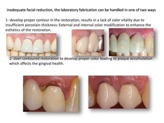 inadequate facial reduction, the laboratory fabrication can be handled in one of two ways
1- develop proper contour in the restoration, results in a lack of color vitality due to
insufficient porcelain thickness: External and internal color modification to enhance the
esthetics of the restoration.
2- over-contoured restoration to develop proper color leading to plaque accumulation
which affects the gingival health.
 