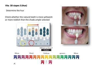 Vita 3D stapes 3 (Hue)
Determine the hue
Check whether the natural tooth is more yellowish
or more reddish than the shade ample selected
 