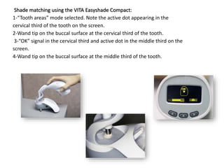 Shade matching using the VITA Easyshade Compact:
1-“Tooth areas” mode selected. Note the active dot appearing in the
cervical third of the tooth on the screen.
2-Wand tip on the buccal surface at the cervical third of the tooth.
3-“OK” signal in the cervical third and active dot in the middle third on the
screen.
4-Wand tip on the buccal surface at the middle third of the tooth.
 