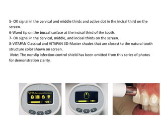 5- OK signal in the cervical and middle thirds and active dot in the incisal third on the
screen.
6-Wand tip on the buccal surface at the incisal third of the tooth.
7- OK signal in the cervical, middle, and incisal thirds on the screen.
8-VITAPAN Classical and VITAPAN 3D-Master shades that are closest to the natural tooth
structure color shown on screen.
Note: The nonslip infection-control shield has been omitted from this series of photos
for demonstration clarity.
 